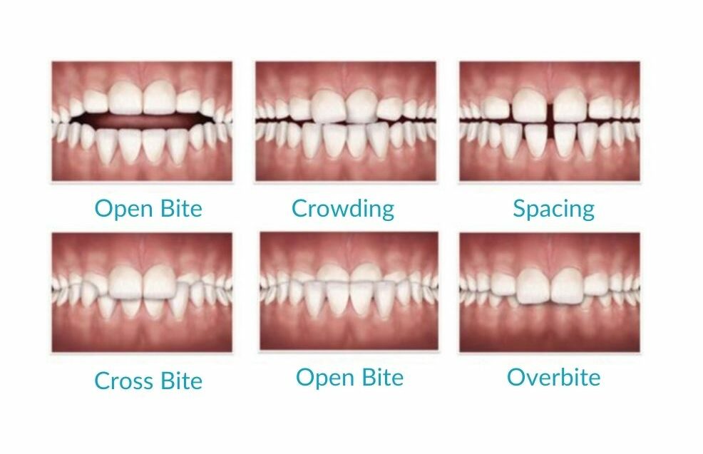 invisalign