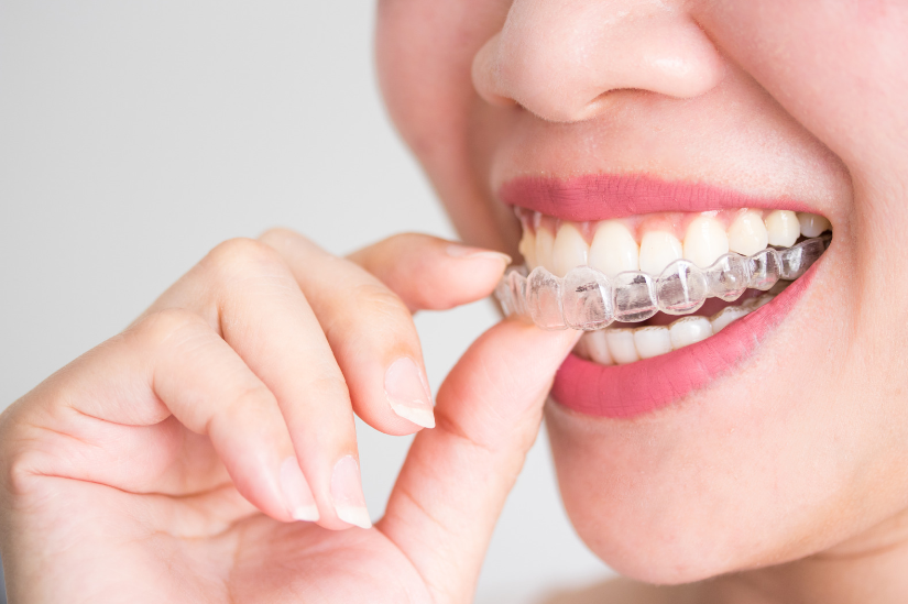 Choosing Between Invisalign And Train Track Braces What You Need To Know New Road Dental In