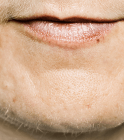 Thin Lips Treatment in Worcestershire