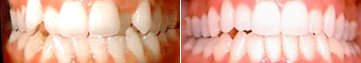 Invisalign Dental Transformation