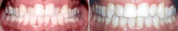 Invisalign Results