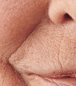 Anti Aging Wrinkle Treatments