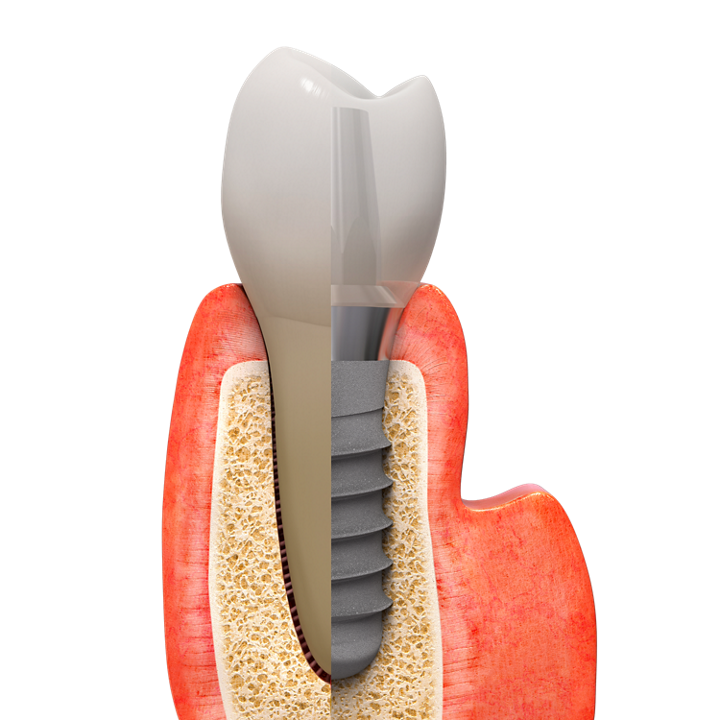 Dental Implant Treatment in Worcestershire