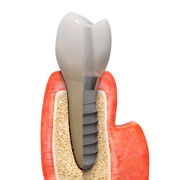 Dental Implant Treatment in Worcestershire