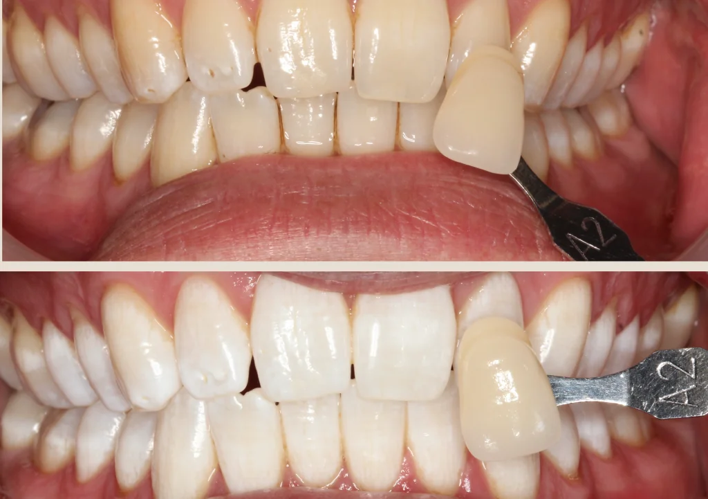 Enlighten whitening – New Road -4 Enlighten whitening - New Road -4